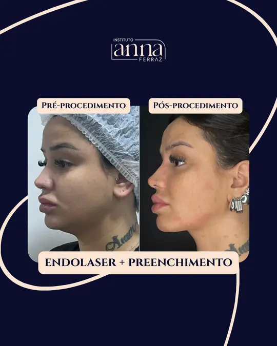 Antes e depois de harmonização orofacial — Endolaser + Preenchimento, resultado real no Instituto Anna Ferraz, São Paulo