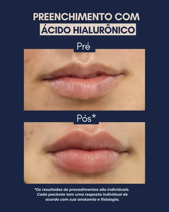 Antes e depois de harmonização orofacial — Preenchimento Labial, resultado real no Instituto Anna Ferraz, São Paulo