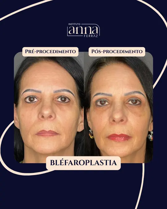 Antes e depois de harmonização orofacial — Blefaroplastia, resultado real no Instituto Anna Ferraz, São Paulo