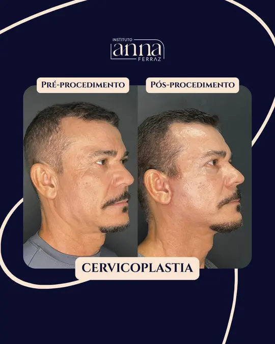 Antes e depois de harmonização orofacial — Cervicoplastia, resultado real no Instituto Anna Ferraz, São Paulo