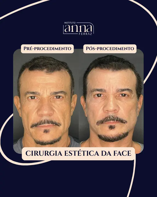 Antes e depois de harmonização orofacial — Cirurgia Estética da Face, resultado real no Instituto Anna Ferraz, São Paulo