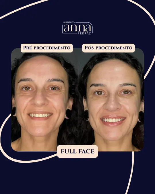 Antes e depois de harmonização orofacial — Full Face, resultado real no Instituto Anna Ferraz, São Paulo