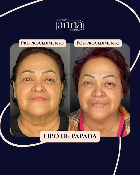 Antes e depois de harmonização orofacial — Lipo de Papada, resultado real no Instituto Anna Ferraz, São Paulo